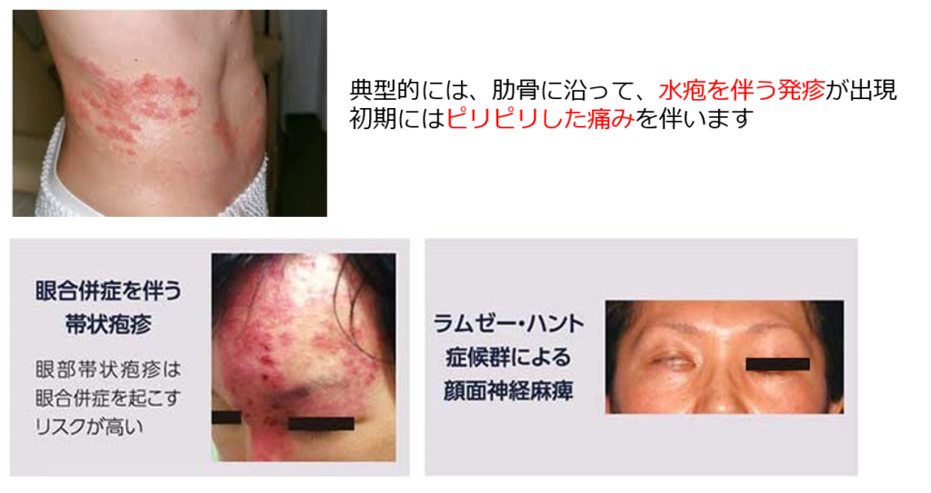 帯状疱疹の症状