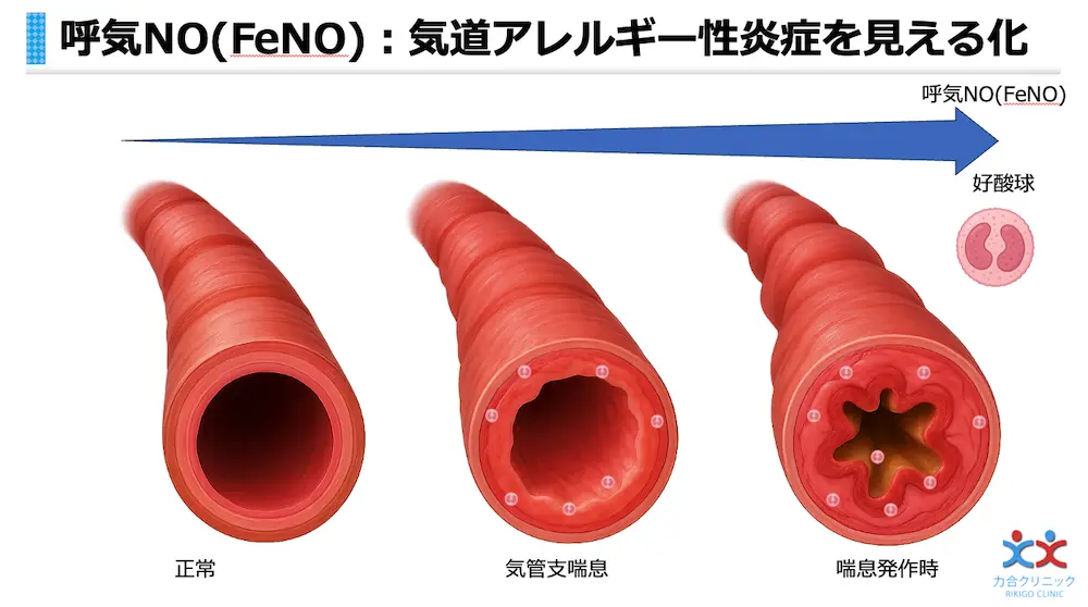 呼気一酸化窒素（呼気NO）検査では気道のアレルギー性炎症を見える化します